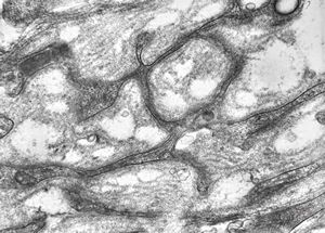 M,15y. | neurinoma n. optici M,15y. | neurinoma n. optici